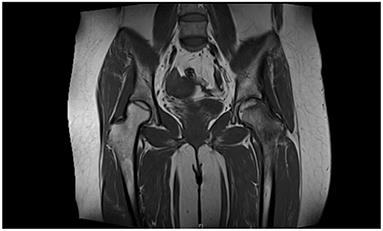 Case report: Directional infusion of peripheral blood stem cells into the necrotic zone in femoral heads through the medial circumflex femoral artery: A tracing study